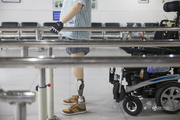 殘疾人裝上智能仿生手 能用電腦刮胡子