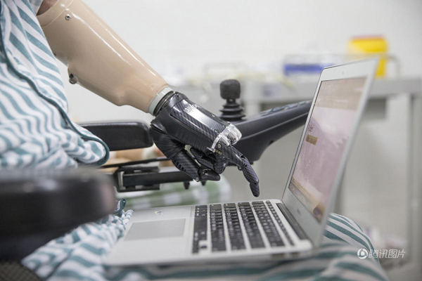 殘疾人裝上智能仿生手 能用電腦刮胡子